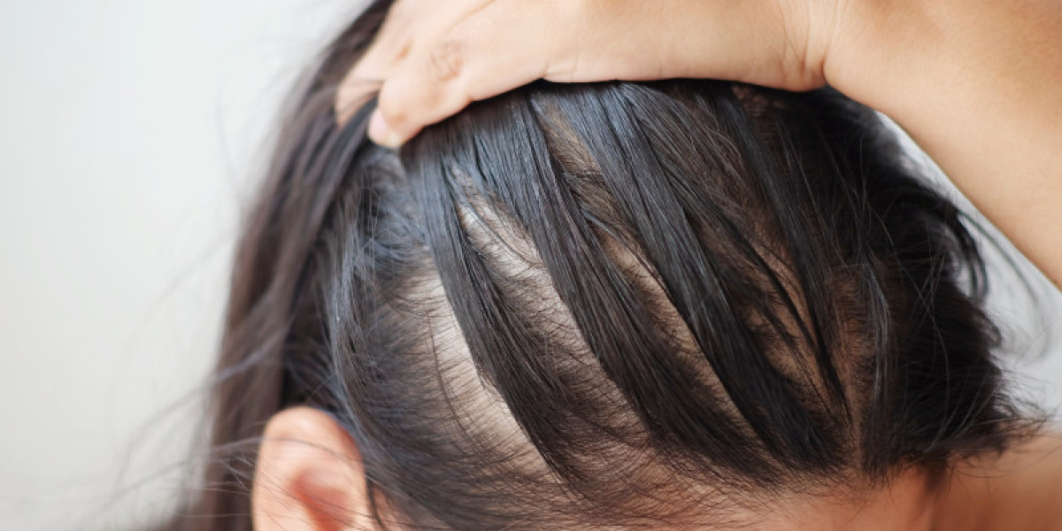Hair Loss Treatment in India: Options and Solutions for Hair Loss