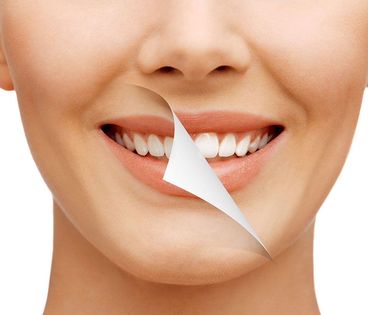 Zoom Teeth Whitening for Tooth Discoloration in Hamilton, ON