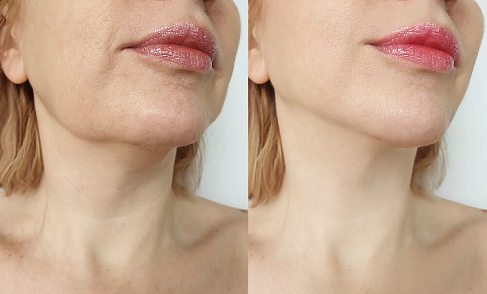 Neck Liposuction (NeckLipo) in 2025: Define Your Jawline and Refresh Your Profile