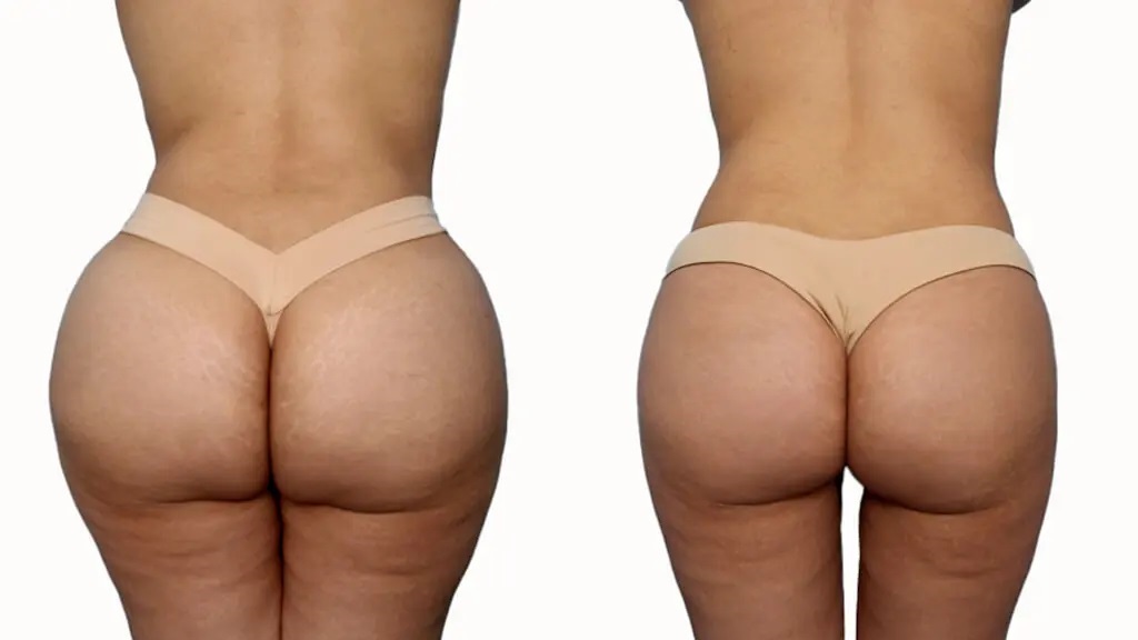 Brazilian Butt Lift (BBL) Surgery in San Francisco