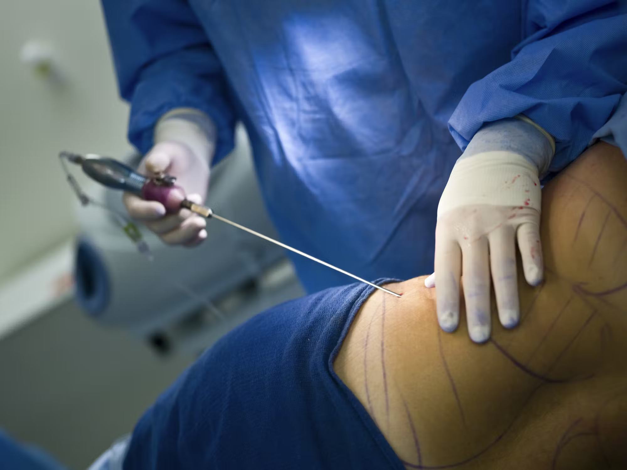 Top 3 Plastic Surgery Procedures Men Are Choosing in 2025