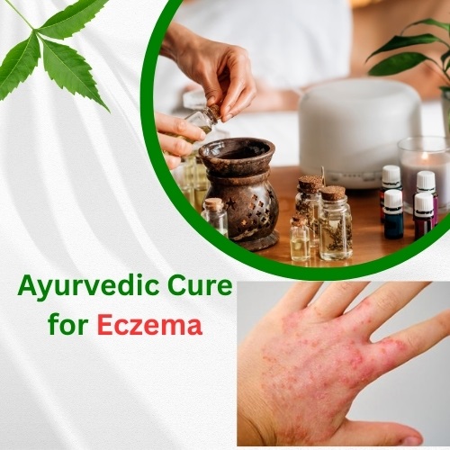 Ayurvedic Cure for Eczema: Natural Solutions for Lasting Relief - Natural Health News